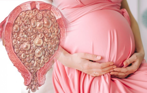 Kaj je grozdna nosečnost, simptomi grozdne nosečnosti