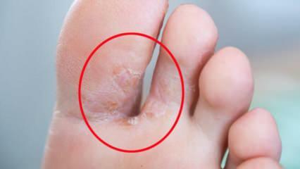 Kaj je glivica na nogah? Kakšni so simptomi gliv na nogah? Ali obstaja zdravilo za stopalo športnika?