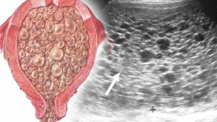 Kaj je molznica (nosečnost iz grozdja), kakšni so simptomi? Kako razumeti krtnost nosečnosti?