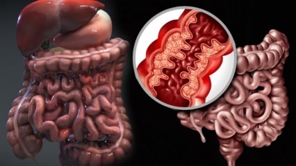 Kaj je Crohnova bolezen? Kakšni so simptomi Crohnove bolezni? Ali obstaja zdravilo za Crohna?