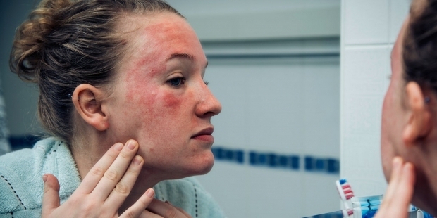 ti se pojavijo na koži osebe s hladno alergijo