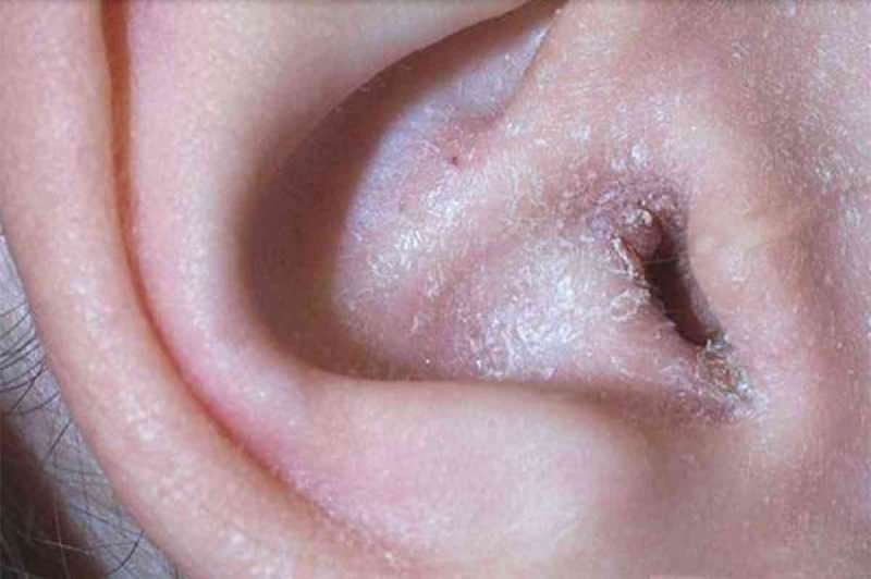Kaj povzroča luščenje za ušesom in kako poteka? Dokončna rešitev za ekcem za ušesi ...