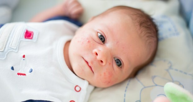 Zakaj se pri dojenčkih pojavijo akne?