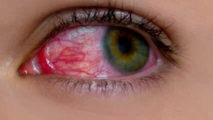 Kaj povzroča alergijo oči? Kakšni so simptomi očesne alergije? Kaj je dobro za očesne alergije? 