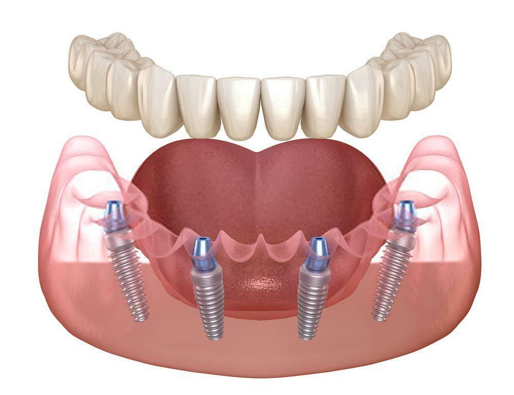 ALI LAHKO VSTAVIM IMPLANTAT TAKOJ PO PULJENJU ZOBA?