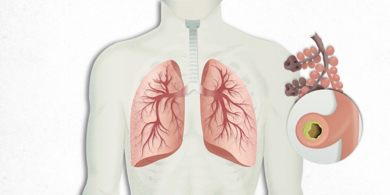 virus, ki se naseli v pljučih, se meša s pljučnico