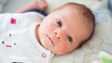 Kako akne prehajajo na otrokov obraz? Načini sušenja aken (Milia)