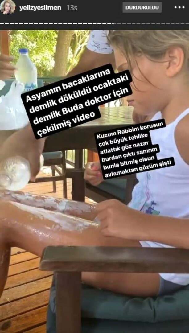 Na nogah hčere Yeliz Yeşilmen se je vlila vrela voda