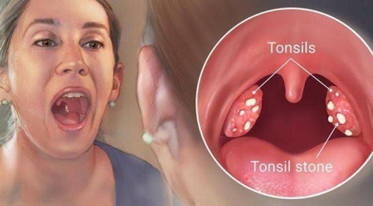 tonzilitis se imenuje otekanje tonzil