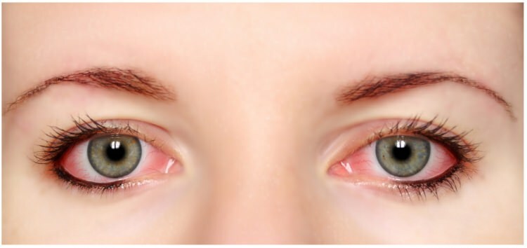 Ali alergija na maskaro in eyeliner v očeh?