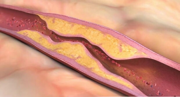 Kaj povzroča aterosklerozo? Koliko vrst vaskularne okluzije obstaja?