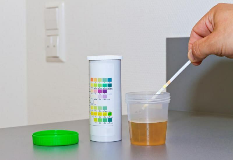 raven bilirubina se običajno pojavi pri testu urina