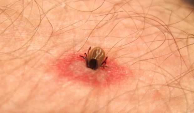 Kakšen ugriz žuželke je, kako? Simptomi ugrizov žuželk! Naravna metoda za ugrize komarjev