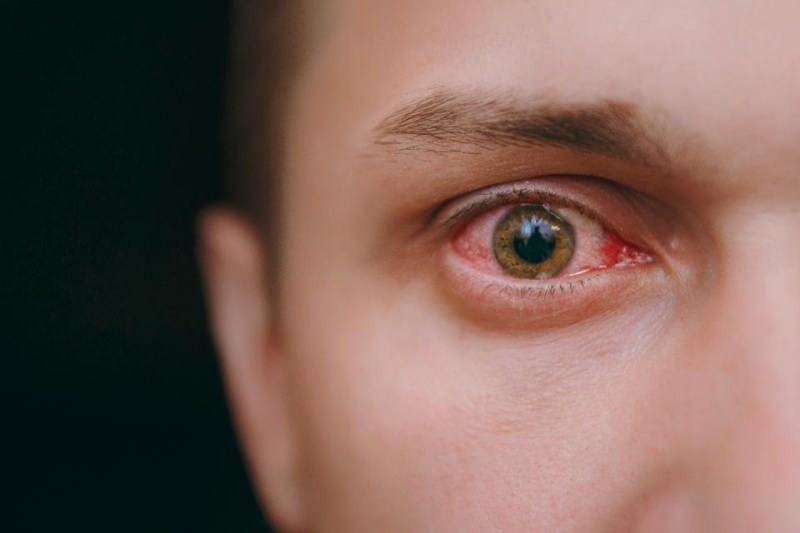 simptomi očesnega zalivanja, krvavitve in srbenja koronavirusa