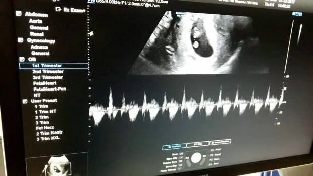 Kdaj se zasliši srčni utrip otroka v maternici? Če otrokovega srčnega utripa ni slišati ...