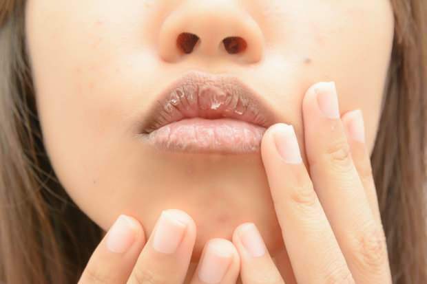 anemija povzroča suhe ustnice