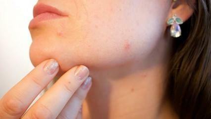 Kaj je kožni rak (melanom)? Kakšni so simptomi melanoma in ali obstaja zdravilo?