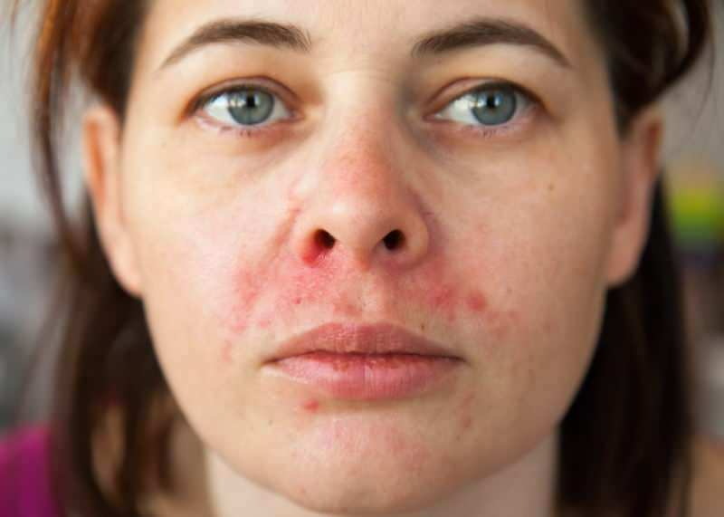 Zakaj se okoli ustnice pojavijo akne? Kako se zdravi občasni dermatitis?