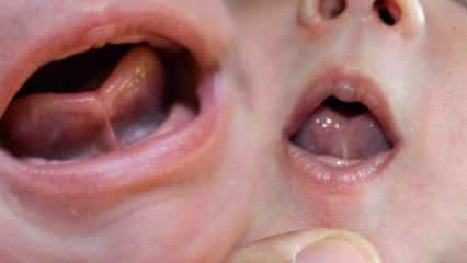 Kakšna je jezikovna vez (Ankyloglossi) pri dojenčkih? Simptomi in zdravljenje jezika ...