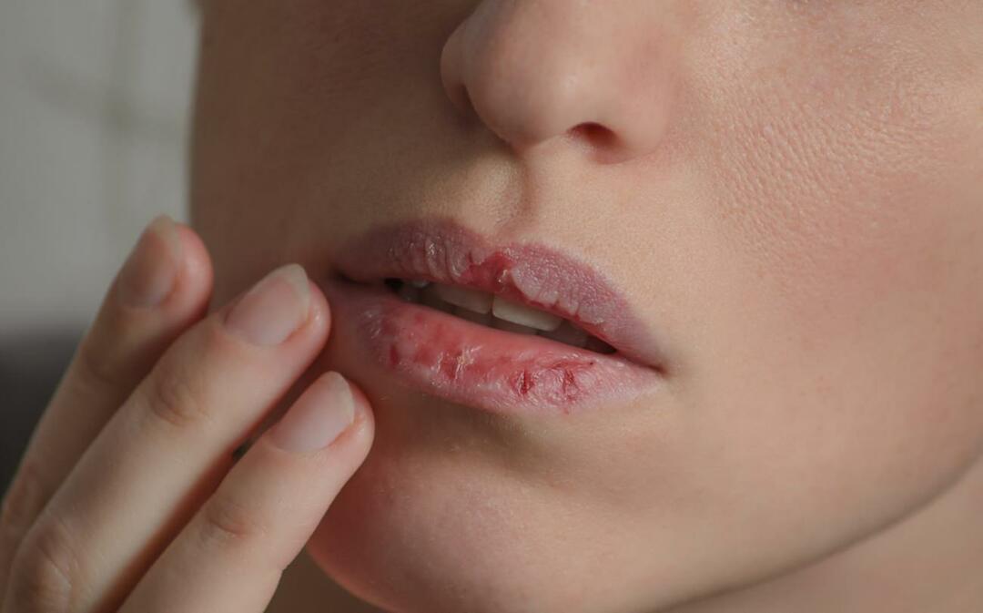 Kaj povzroča temne ustnice? Kako se zdravijo temne ustnice ali modrice?