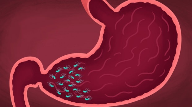 nekateri virusi in bakterije lahko povzročijo gastritis