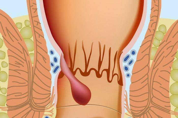 Kako se hemoroidi pojavijo v analnem delu 