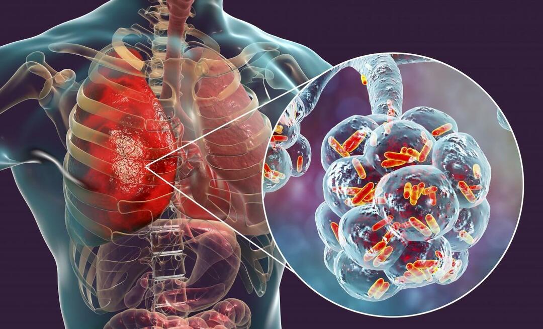 Kaj je pljučnica in kakšni so njeni simptomi? Kako se zdravi nova epidemija virusa pljučnice?
