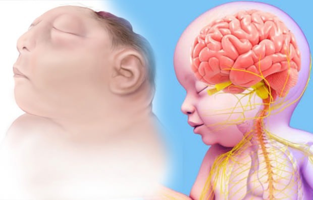 Ali dojenček Anencefalija živi? Diagnoza ancencefalije
