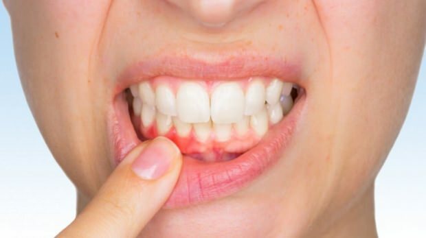 Pogoste težave z dlesni