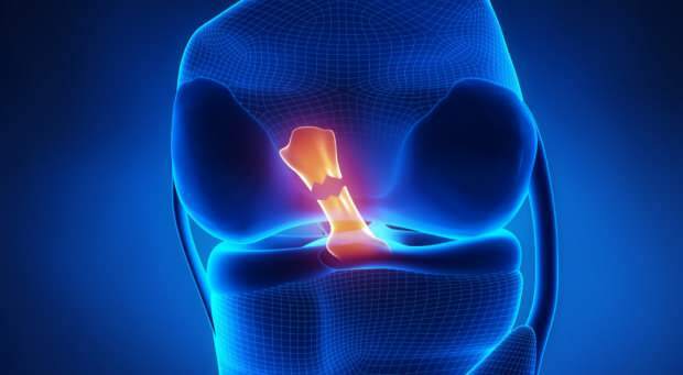Kaj povzroča rupturo križnega ligamenta in kakšni so simptomi? Ali obstaja križni ligament?