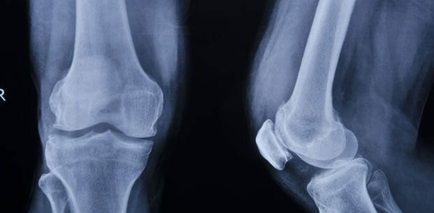 Izguba teže ustavi kalcifikacijo kolena