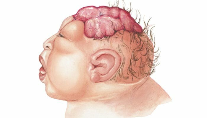Kaj je Anencefalija? Kakšni so simptomi Anencefalije pri dojenčkih in otrocih? Anencefalija povzroča ...