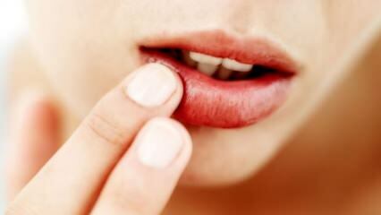 Kaj je dobro za pokanje ustnic?