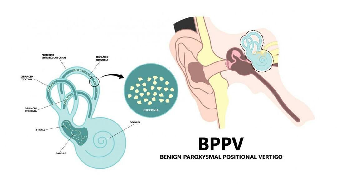 Zakaj se glava vrti, ko leži? Kaj je dobro za benigno paroksizmalno pozicijsko vrtoglavico? Kako se znebiti BPPV