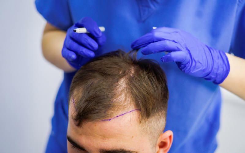 Ali je dovoljeno presaditev las pri zdravljenju izpadanja las? Kaj so protetični lasje? Ali protetični lasje ovirajo ghusl?