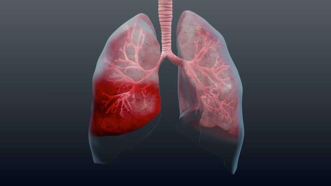 Kaj je pljučnica in kakšni so njeni simptomi? Kako se zdravi nova epidemija virusa pljučnice?