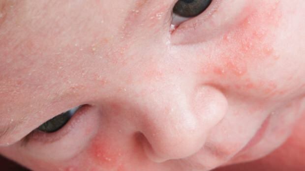 Kako akne preidejo pri dojenčkih?