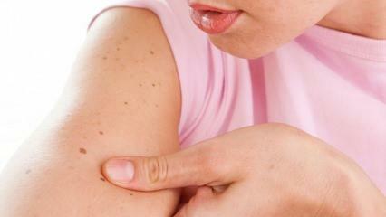 Kaj je kožni (kožni) rak in kakšni so njegovi simptomi? Načini razumevanja kožnega raka