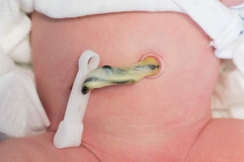 Kdaj se pri dojenčkih prereže popkovina? Prednosti rezanja popkovine pozno