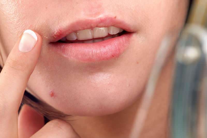 herpes običajno izhaja na robu ustnice.