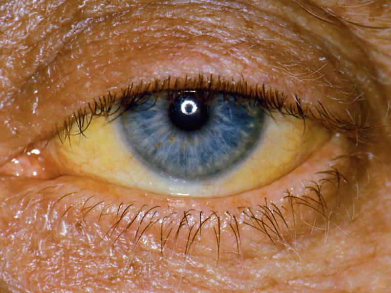 višina na ravni bilirubina povzroča rumeno barvo na očeh in koži