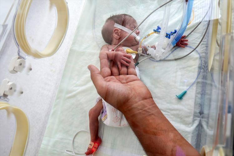 'Čudežni dojenček' je uspel preživeti operacijo
