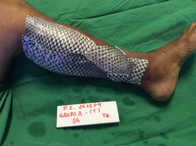 Koža rib je prešla v anamnezo pri zdravljenju opeklin
