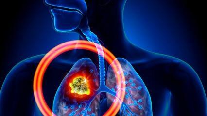 Kakšni so simptomi pljučnega raka? Ali obstaja zdravljenje pljučnega raka?
