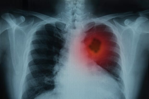 Kakšni so simptomi pljučnega raka? Ali obstaja zdravljenje pljučnega raka? Za preprečevanje pljučnega raka ...