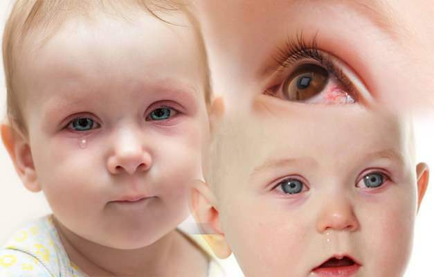 povzroča očesne krvavitve pri dojenčkih