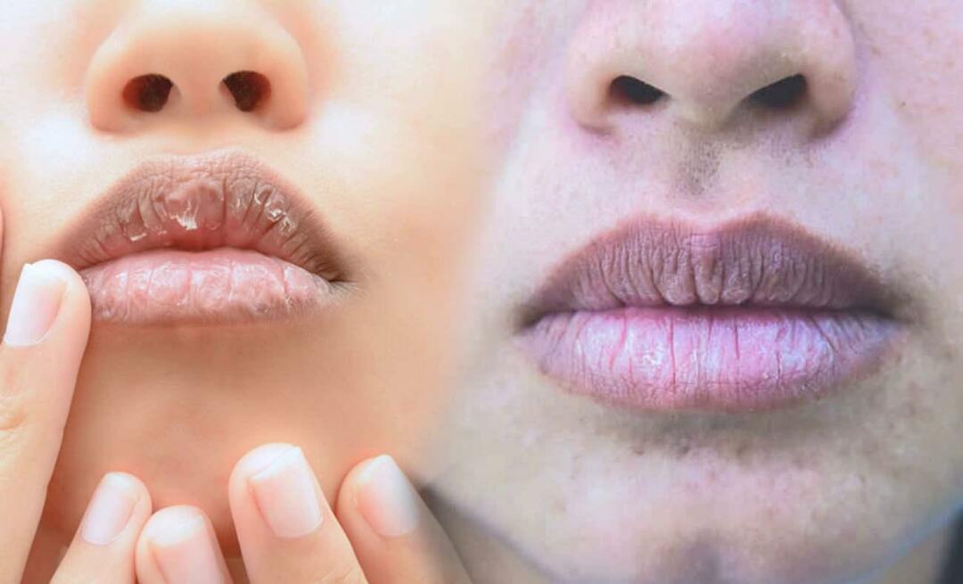 Kaj povzroča temne ustnice? Kako se zdravijo temne ustnice ali modrice?