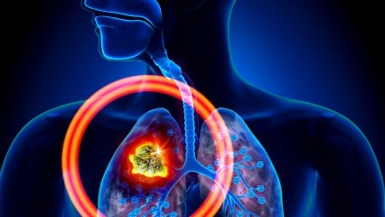 Kakšni so simptomi pljučnega raka? Ali obstaja zdravljenje pljučnega raka? Za preprečevanje pljučnega raka ...