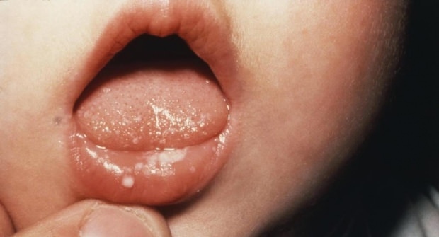 Kako boleče usta pri dojenčkih