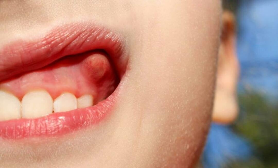 Zakaj pride do abscesa zoba in kakšni so simptomi? Zobni absces, kako se zdravi?